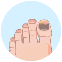 Micosis