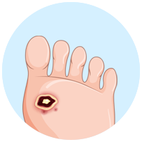 Onicocriptosis