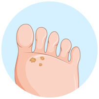 Micosis